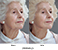 Elderly Before and After Thumbnail